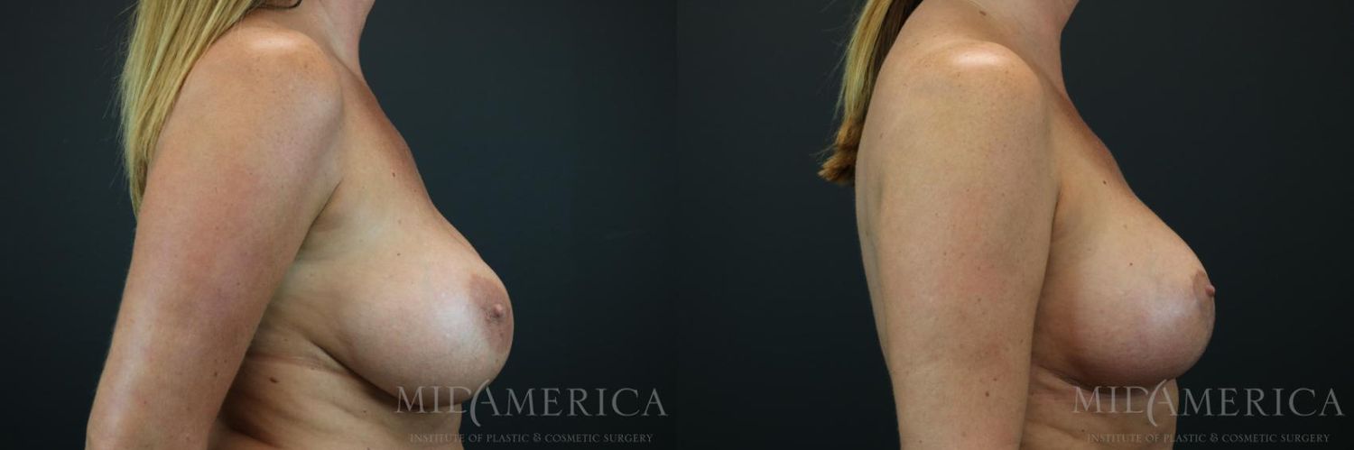 Implant Exchange Before & After