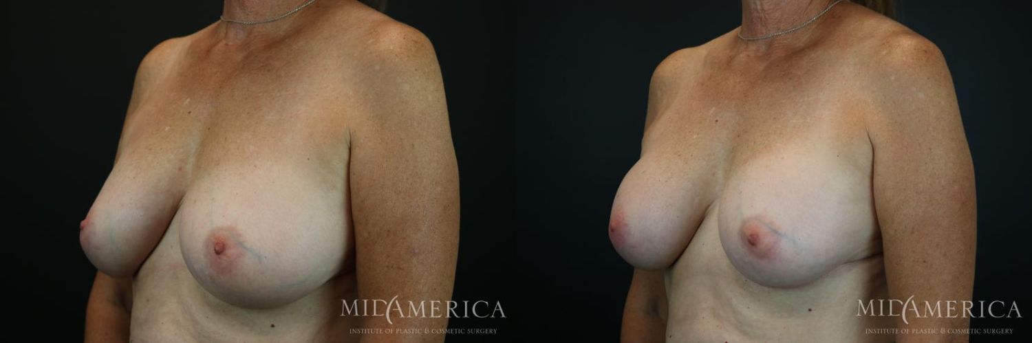 Implant Exchange Before & After