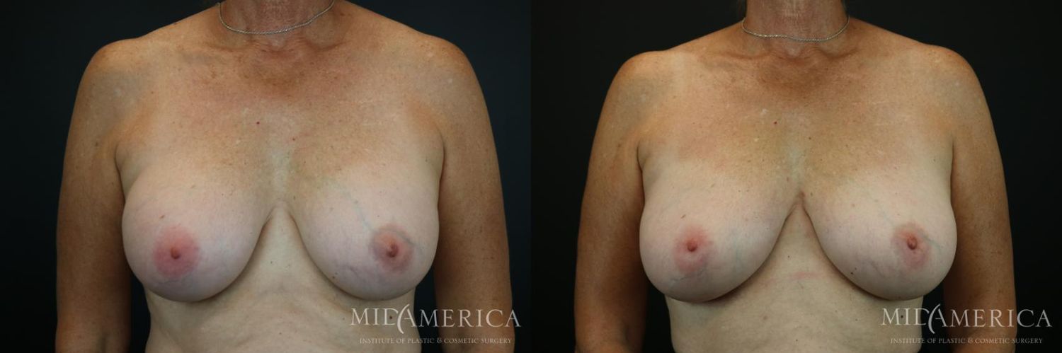 Implant Exchange Before & After