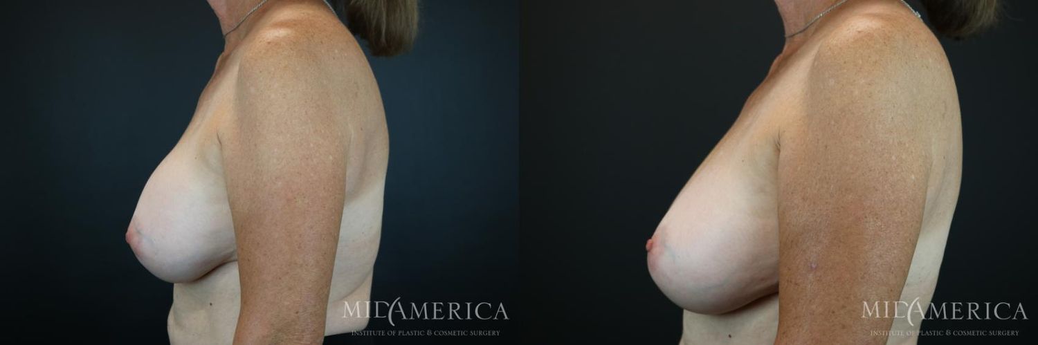 Implant Exchange Before & After