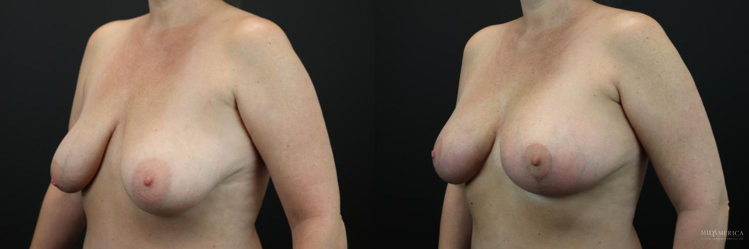 Implant Exchange Before & After