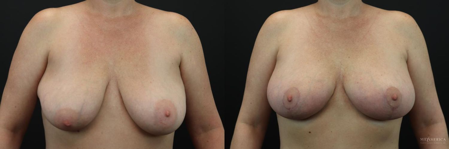 Implant Exchange Before & After