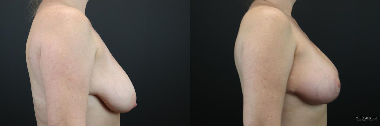 Implant Exchange Before & After