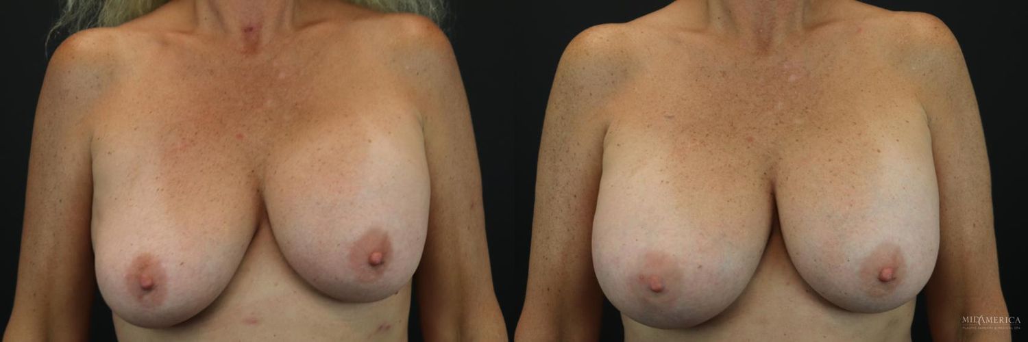 Implant Exchange Before & After