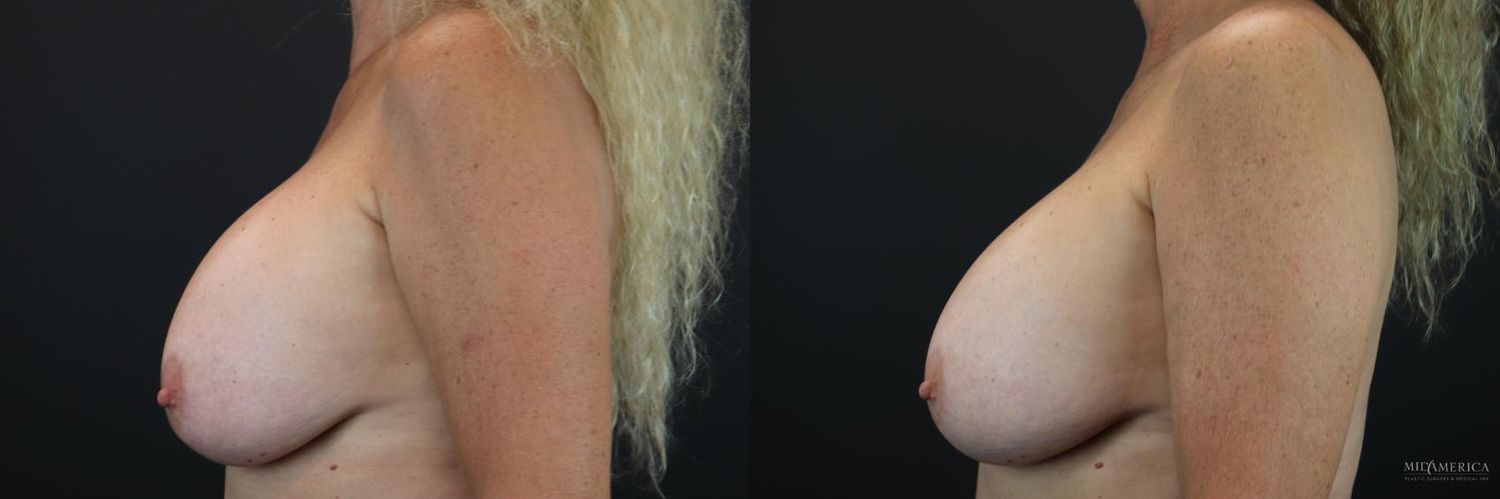 Implant Exchange Before & After