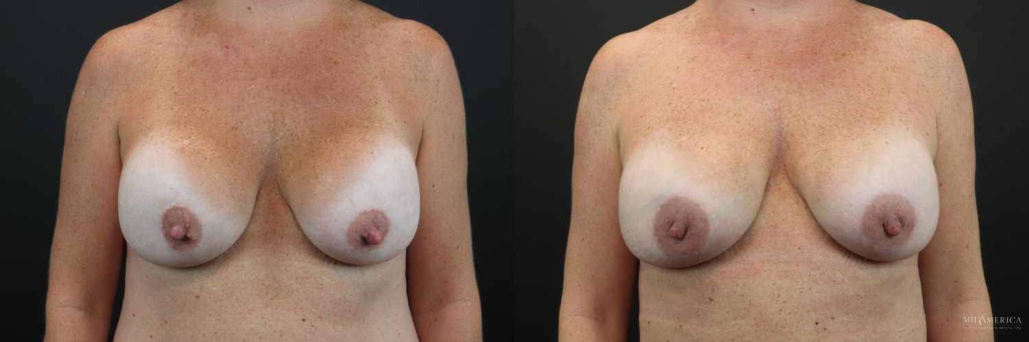 Implant Exchange Before & After