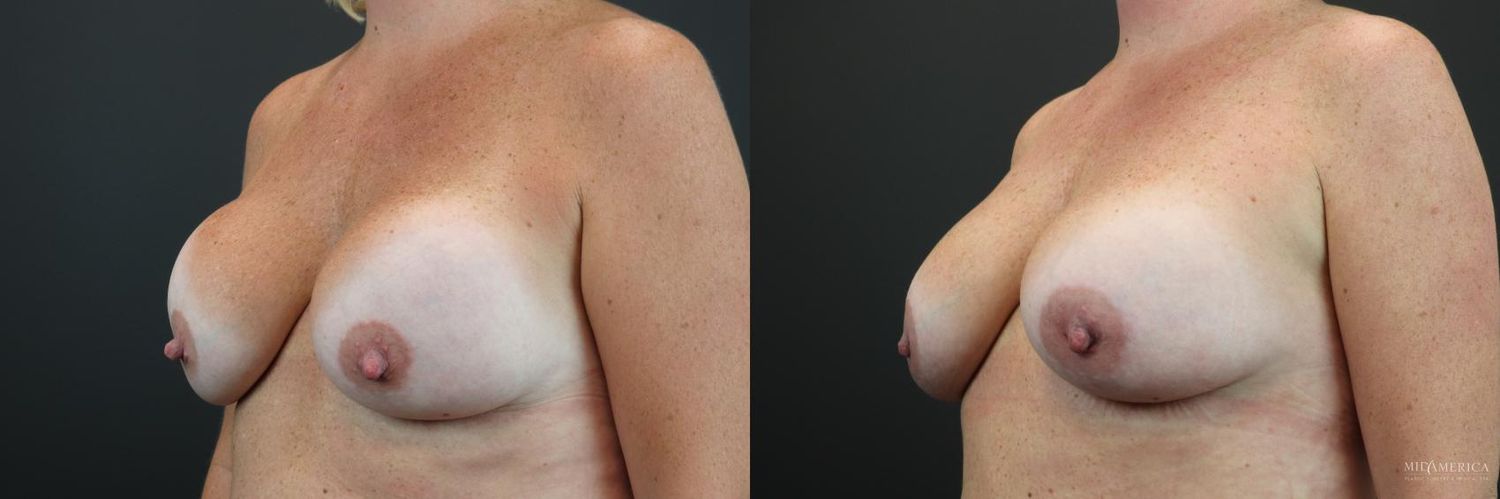 Implant Exchange Before & After