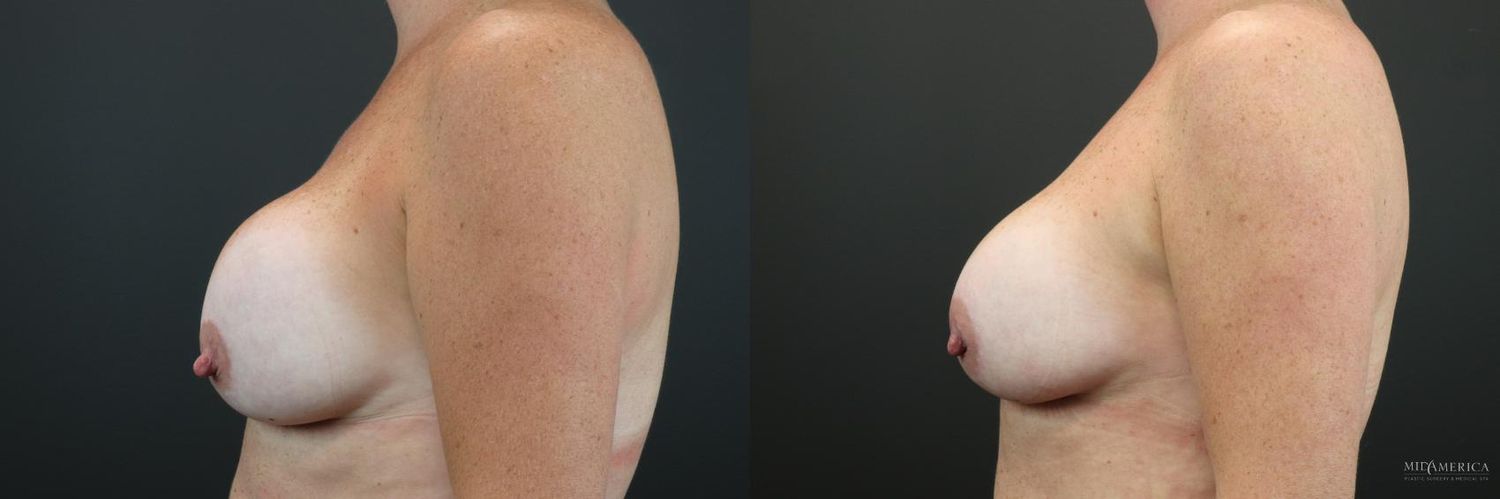 Implant Exchange Before & After