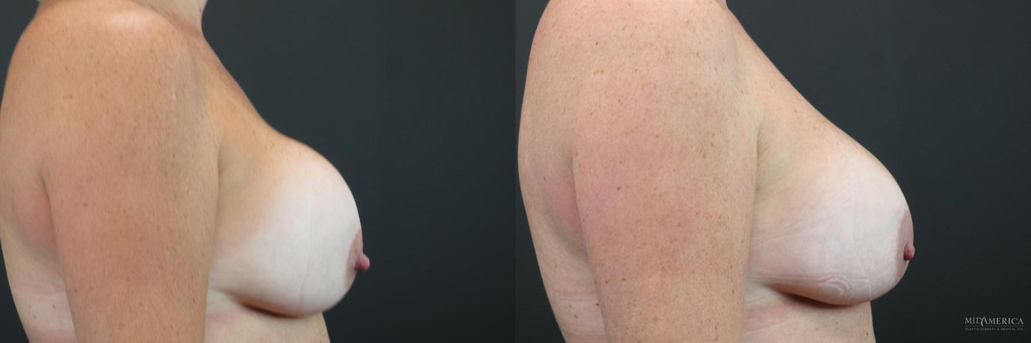 Implant Exchange Before & After