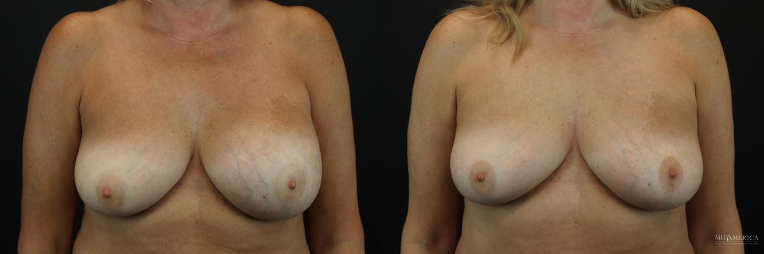 Implant Exchange Before & After