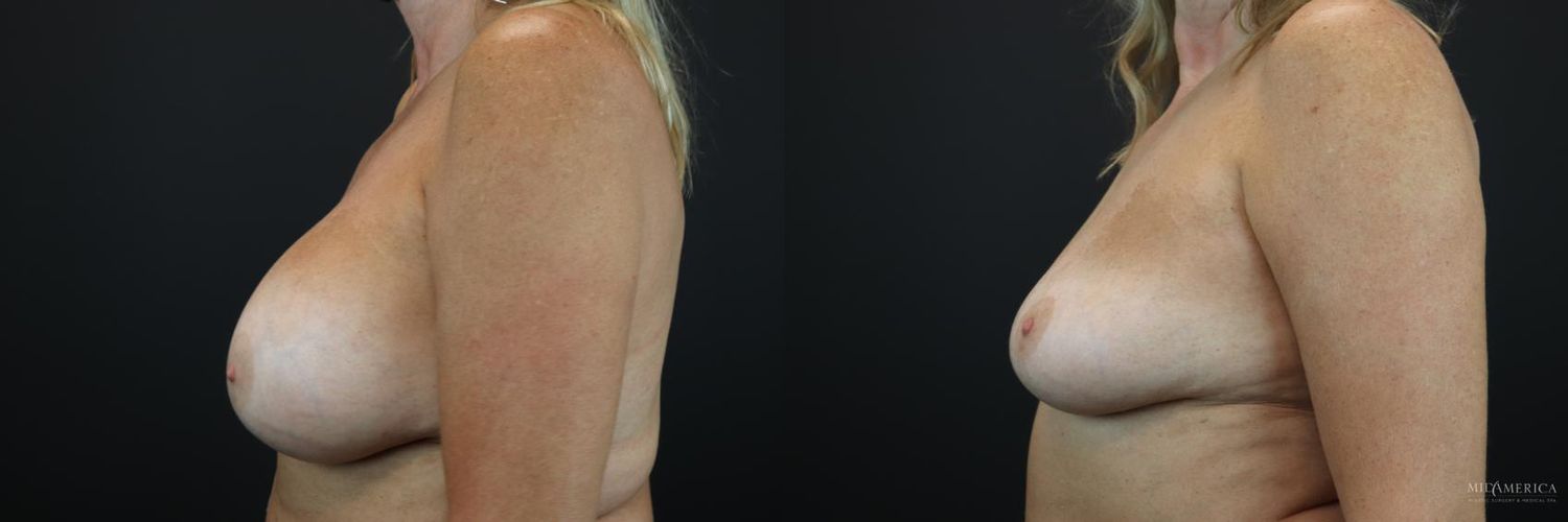 Implant Exchange Before & After