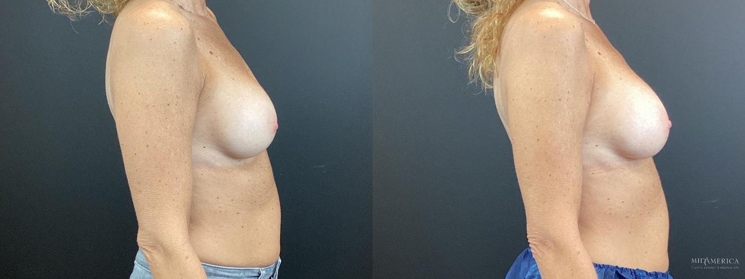 Implant Exchange Before & After