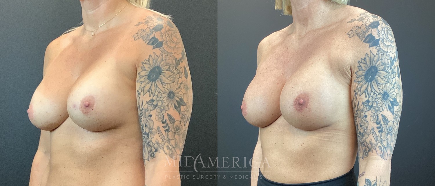 Implant Exchange Before & After