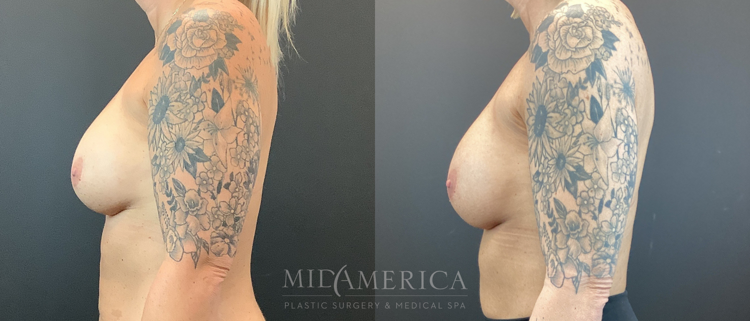 Implant Exchange Before & After