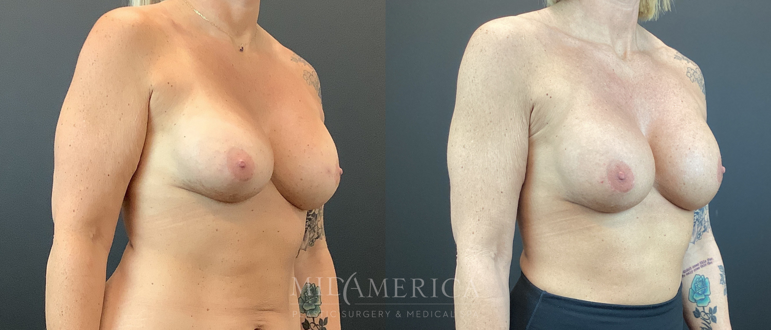 Implant Exchange Before & After