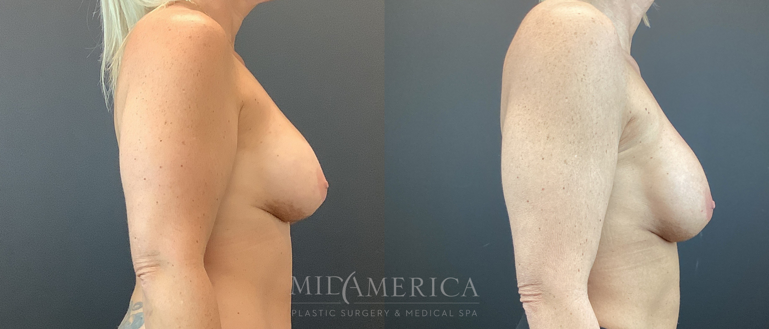 Implant Exchange Before & After