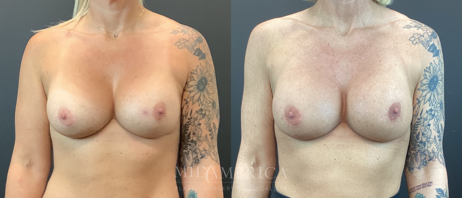 Implant Exchange Before & After