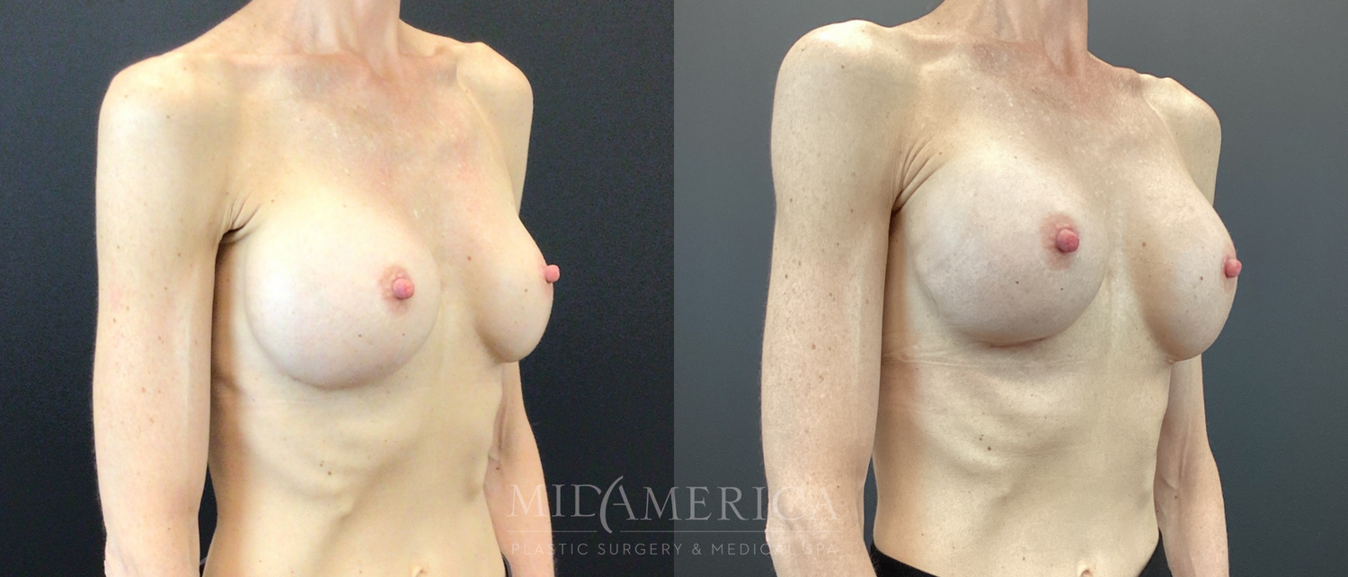 Implant Exchange Before & After