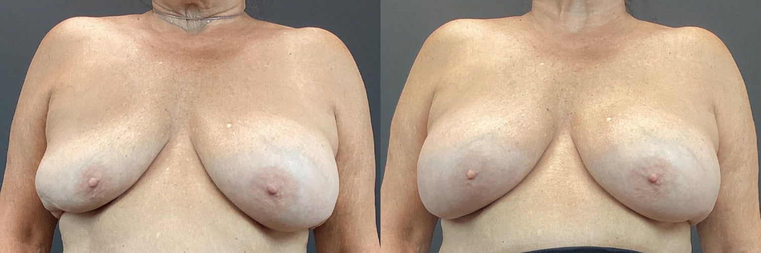 Implant Exchange Before & After