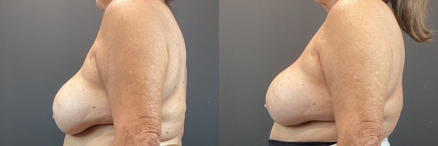 Implant Exchange Before & After