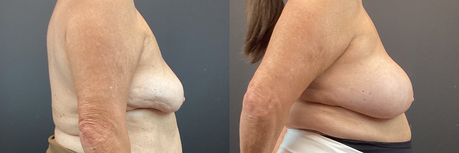 Implant Exchange Before & After