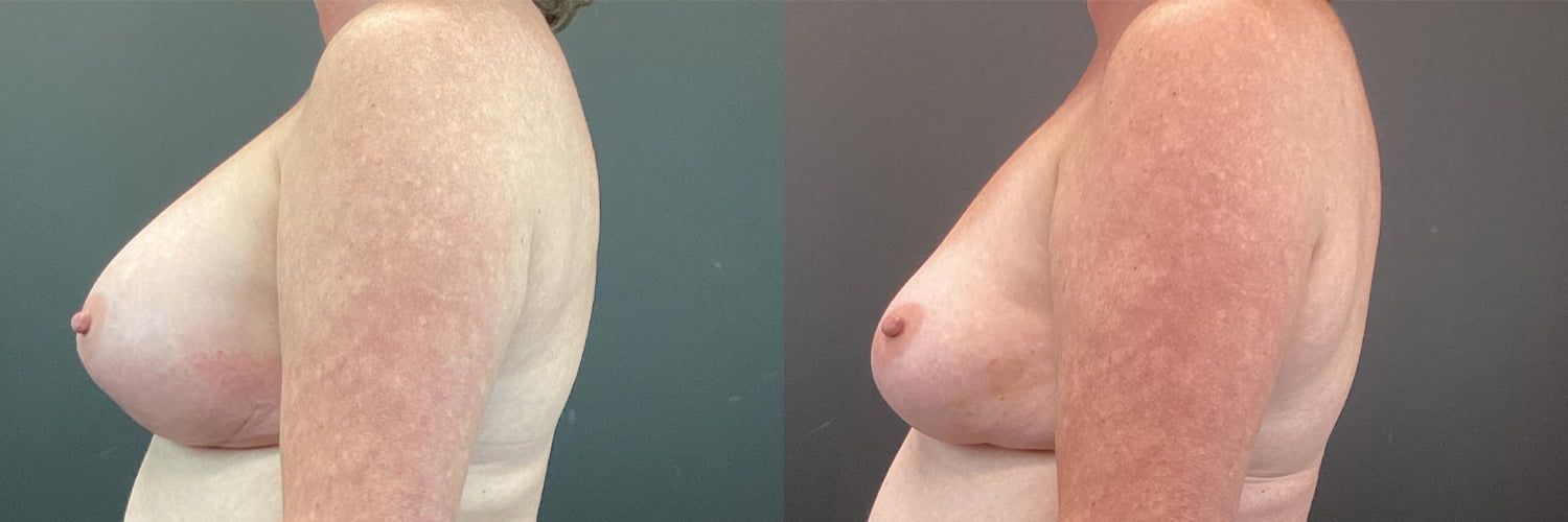 Implant Exchange Before & After