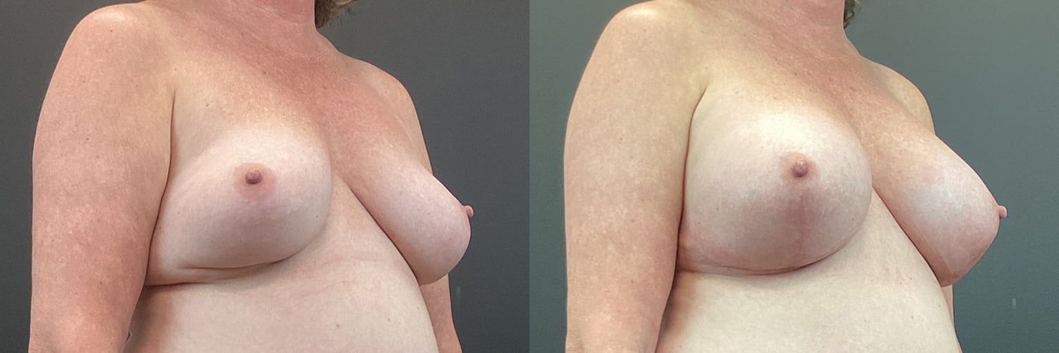 Implant Exchange Before & After