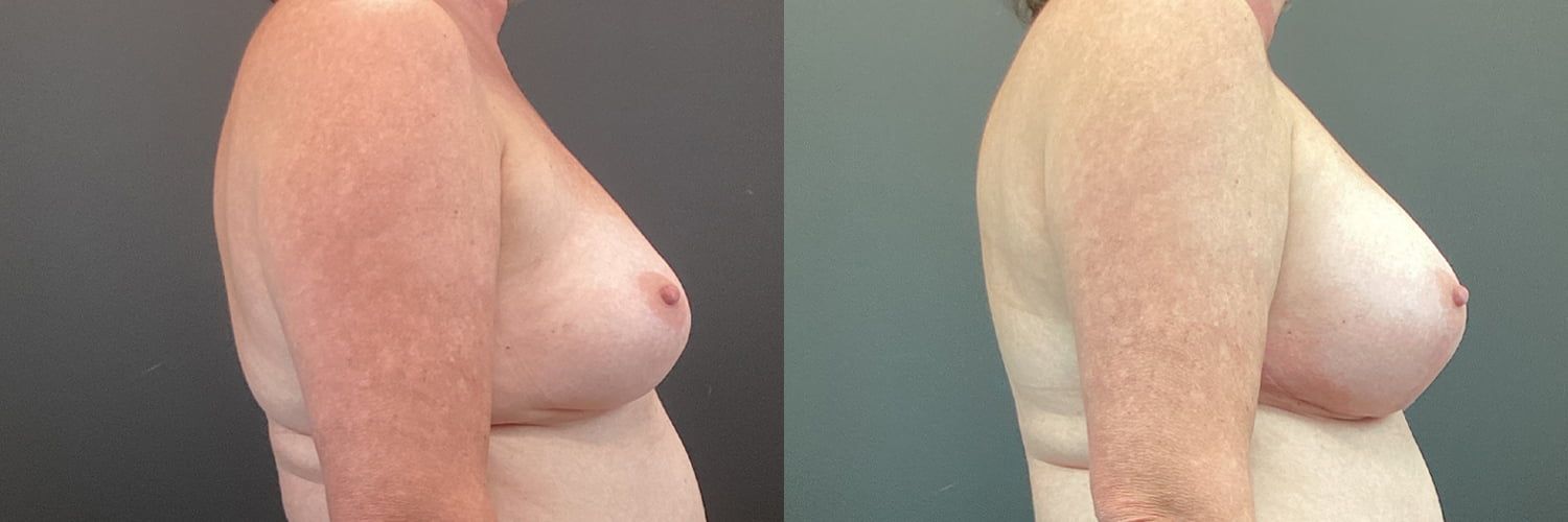 Implant Exchange Before & After