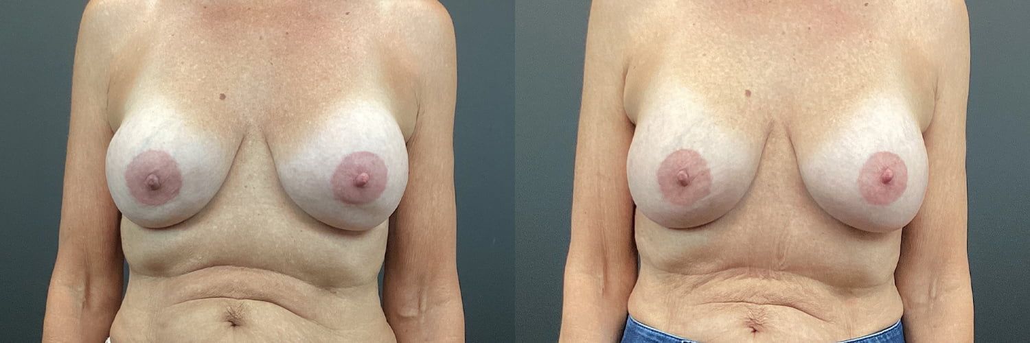 Implant Exchange Before & After