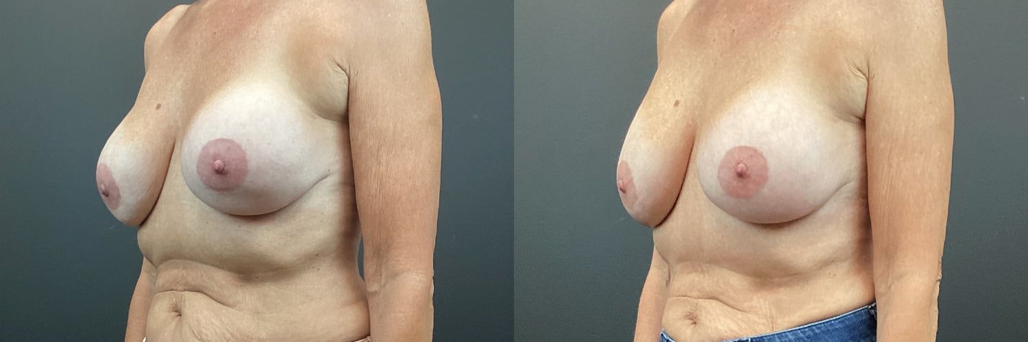 Implant Exchange Before & After