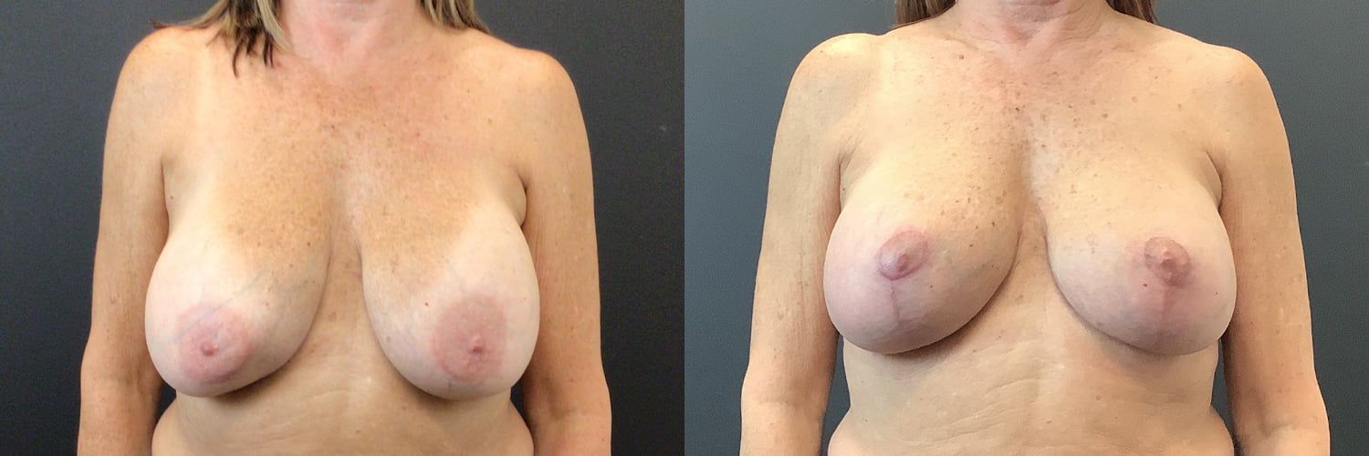 Implant Exchange Before & After