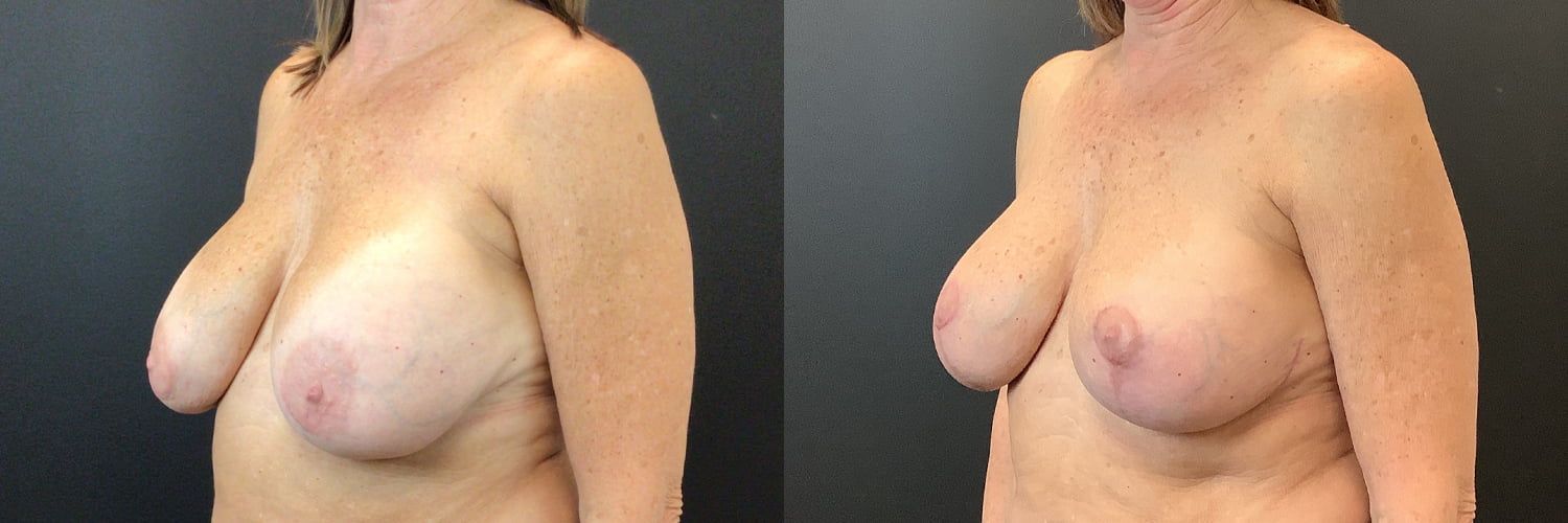 Implant Exchange Before & After