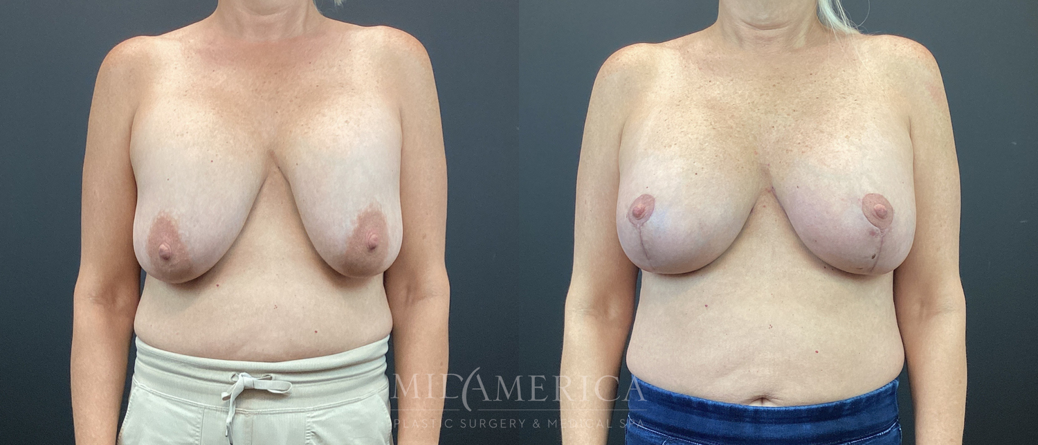 Implant Exchange Before & After