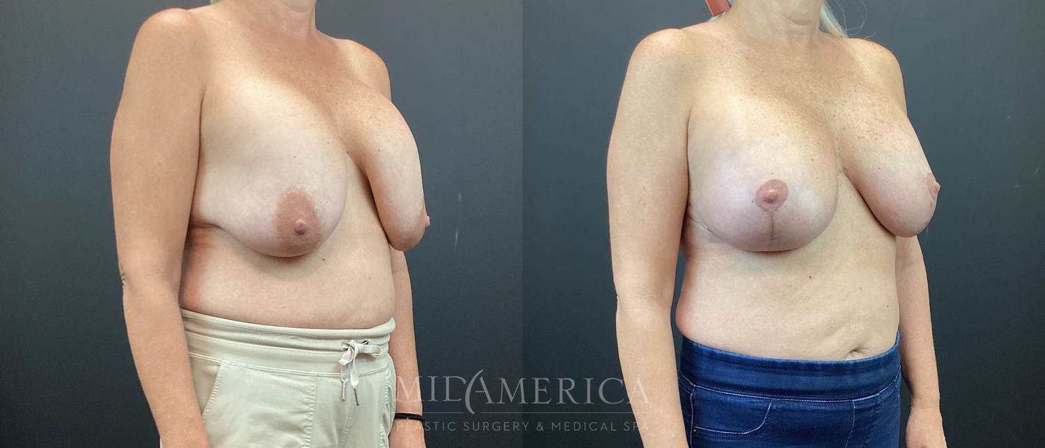 Implant Exchange Before & After