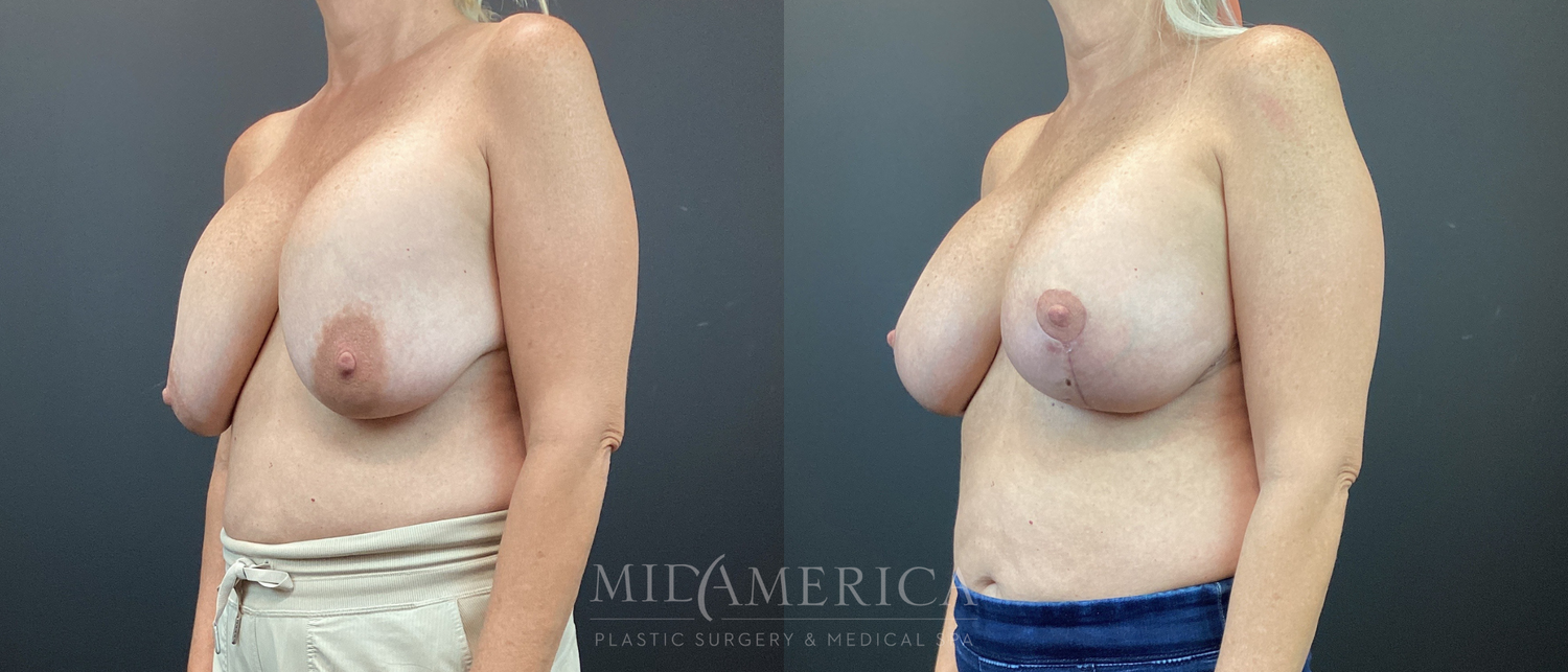 Implant Exchange Before & After