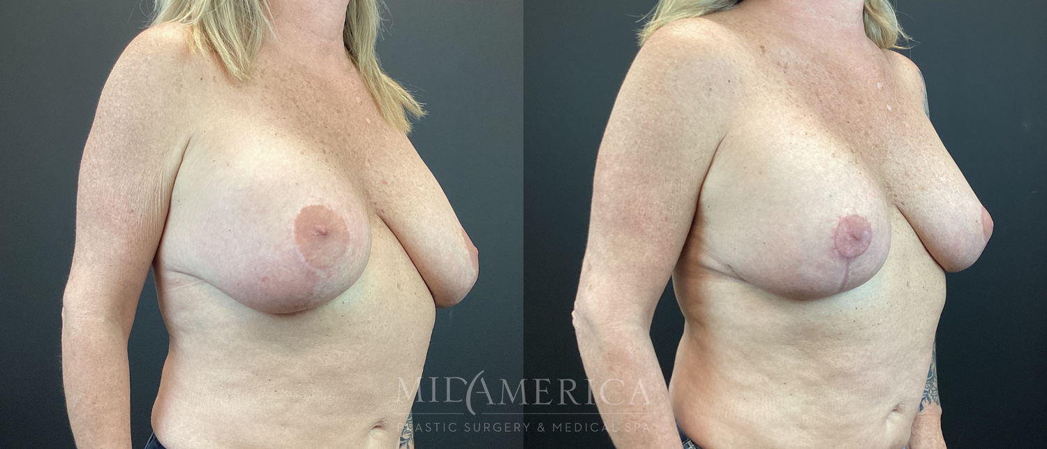 Implant Exchange Before & After