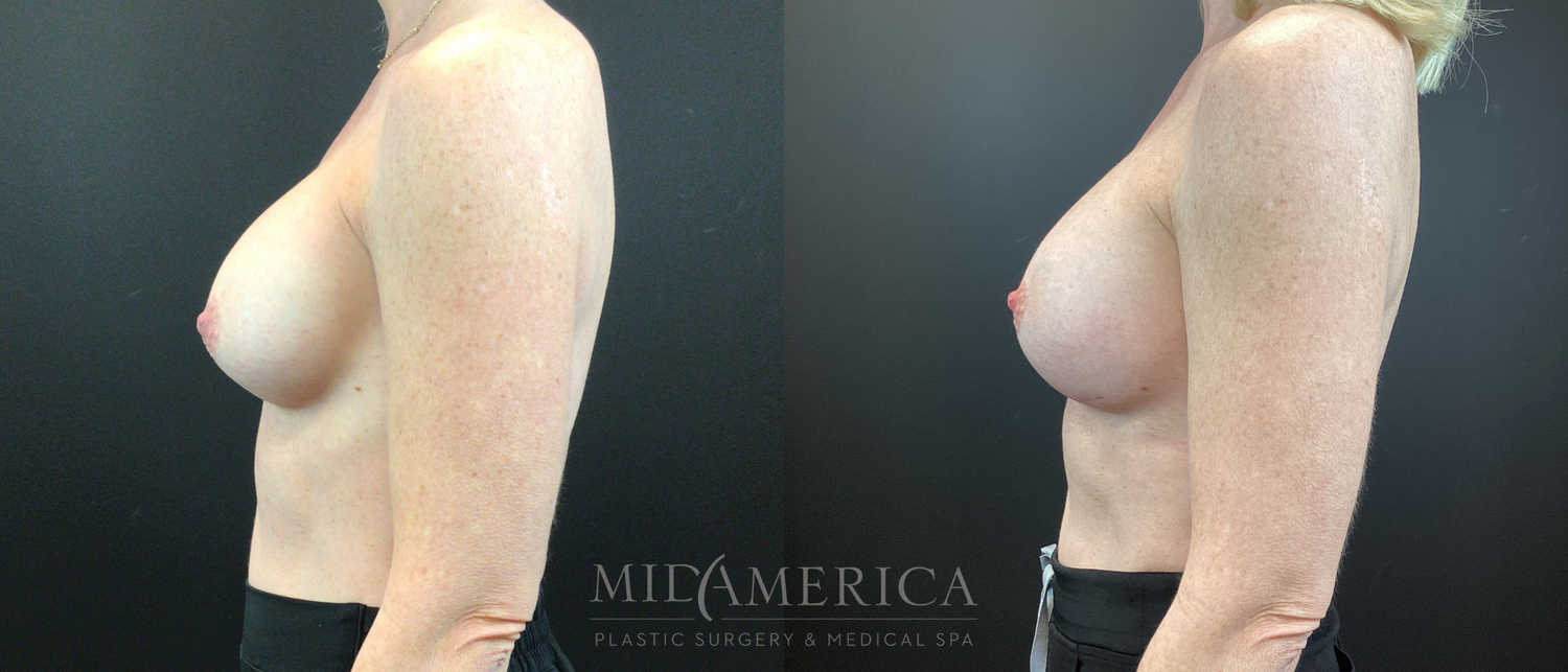 Implant Exchange Before & After