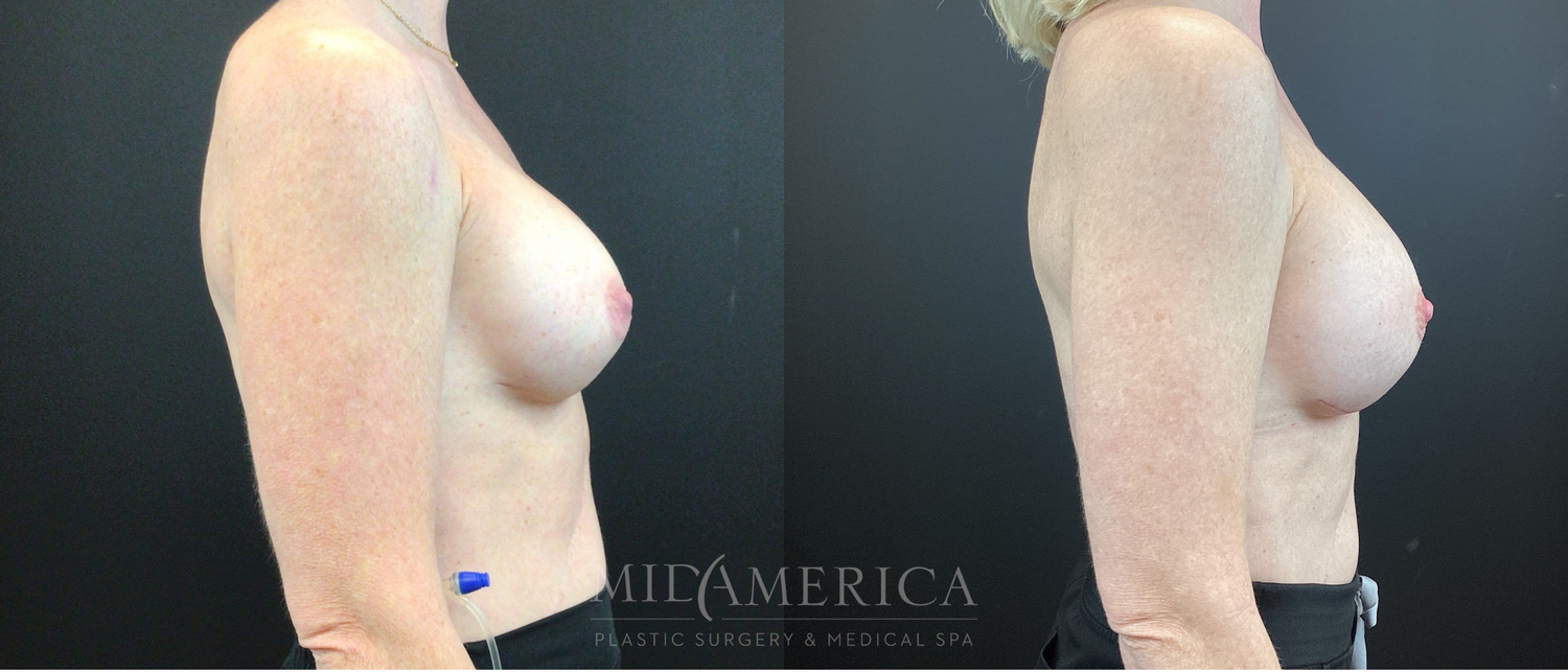 Implant Exchange Before & After