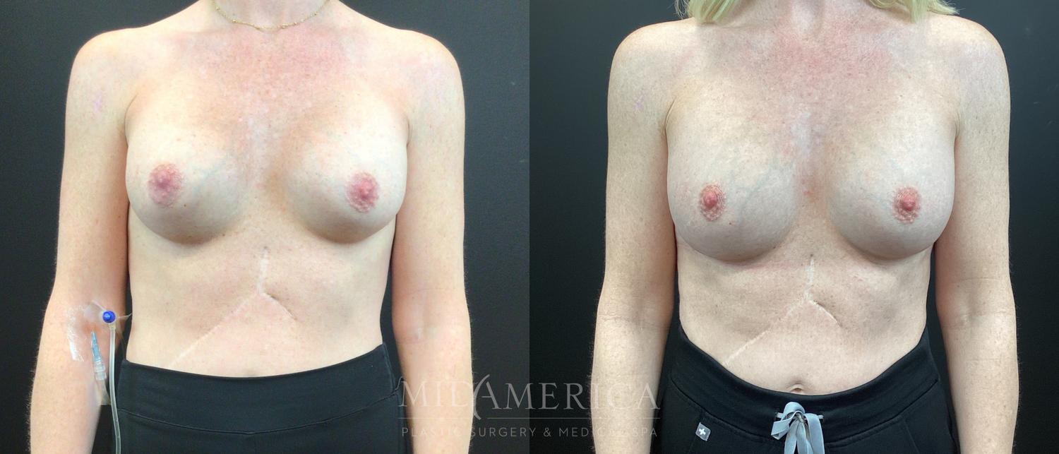 Implant Exchange Before & After