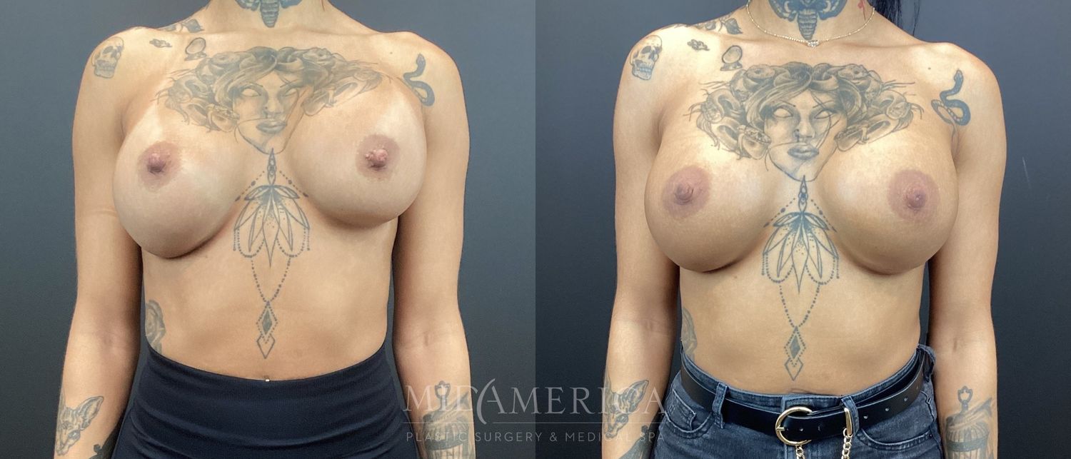 Implant Exchange Before & After