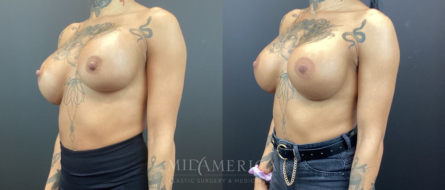 Implant Exchange Before & After