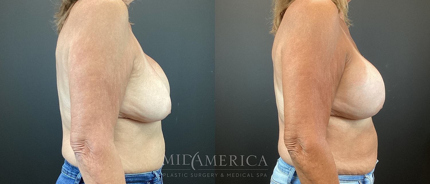 Implant Exchange Before & After