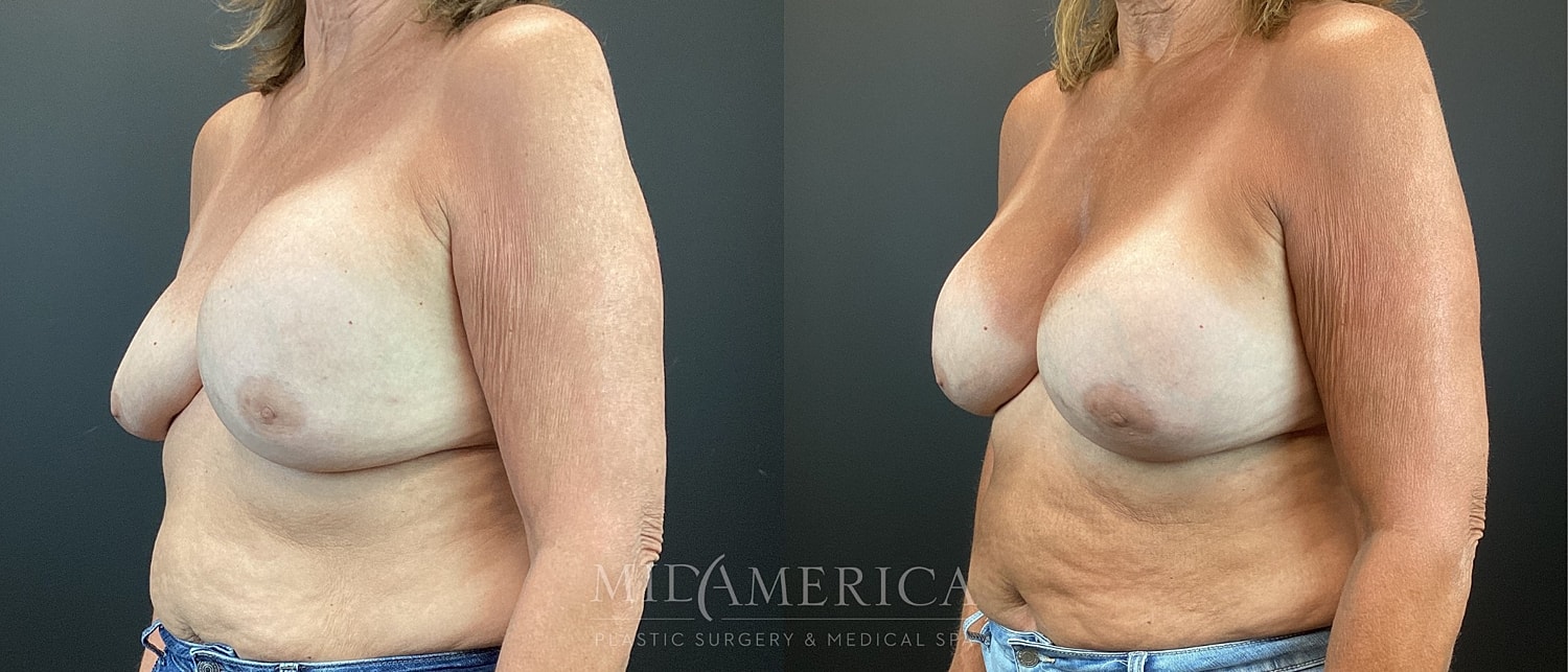 Implant Exchange Before & After