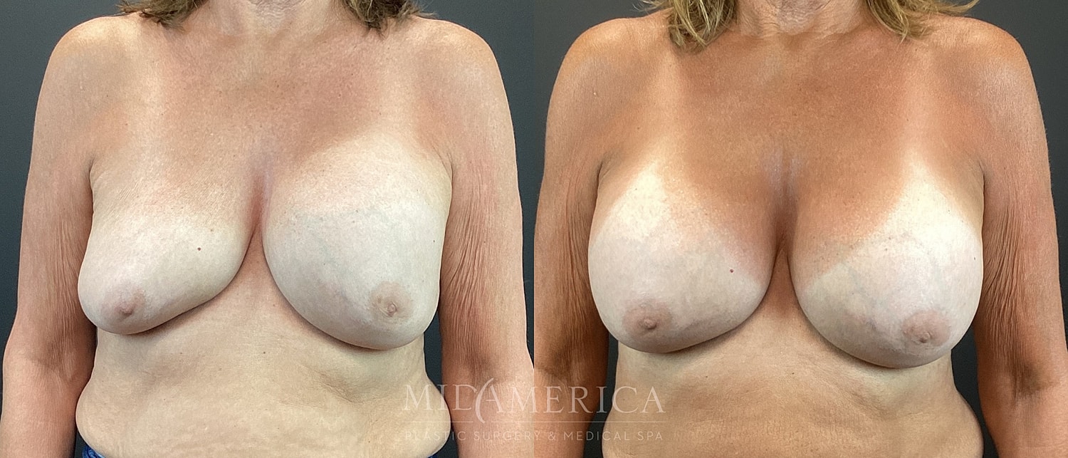 Implant Exchange Before & After