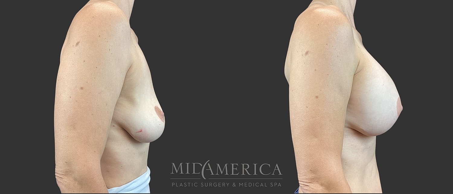 Implant Exchange Before & After