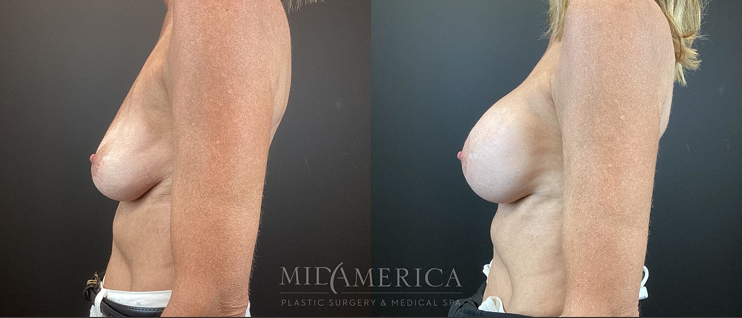 Implant Exchange Before & After