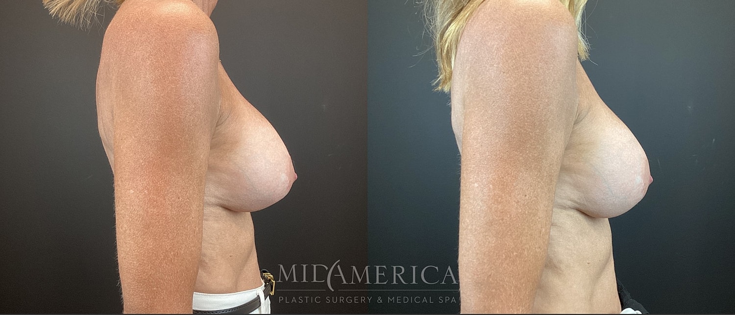 Implant Exchange Before & After