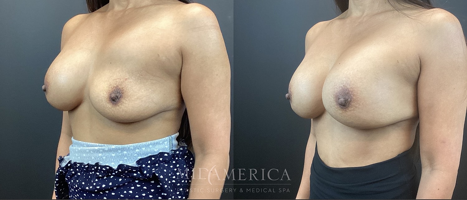 Implant Exchange Before & After