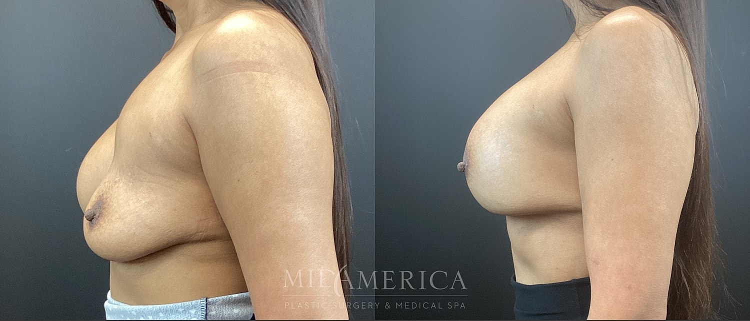 Implant Exchange Before & After