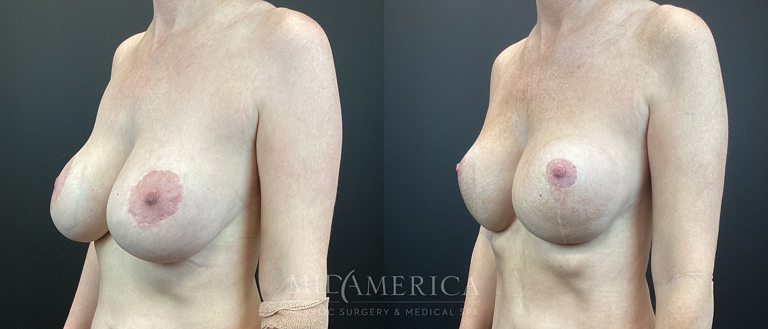 Implant Exchange Before & After